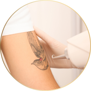 tattoo removal