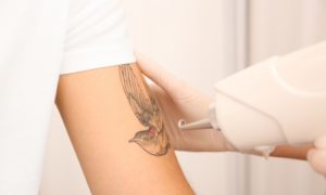 Tattoo Removal
