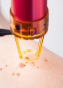 เลเซอร์เนื้องอกผิวหนัง