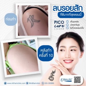 รีวิวลบรอยสักต้นแขน