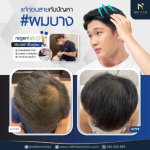 PRP treats thinning hair