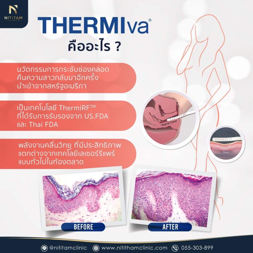 Thermiva กระชับช่องคลอด