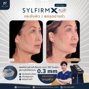 รีวิวเลเซอร์ Sylfirm X Plus