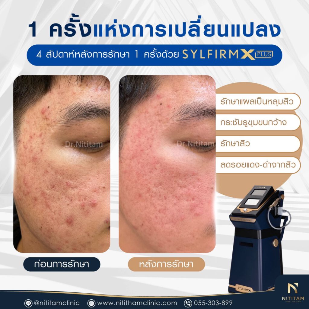 รีวิวเลเซอร์ Sylfirm X Plus