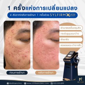 รีวิวเลเซอร์ Sylfirm X Plus