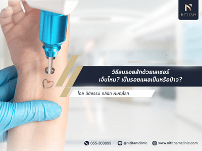 วิธีลบรอยสักด้วยเลเซอร์ เจ็บไหม เป็นรอยแผลเป็นหรือป่าว
