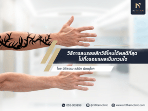 How to remove tattoos