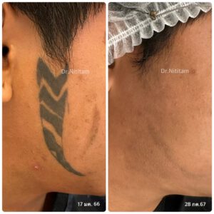 ก่อนและหลัง การลบรอยสัก รีวิวลบรอยสักบนใบหน้า