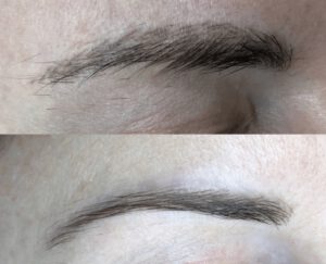 ก่อนและหลัง การลบรอยสัก รีวิวลบสักคิ้ว