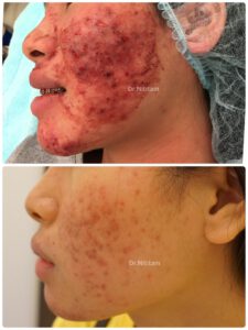 รีวิวรักษาสิว นิติธรรมคลินิก