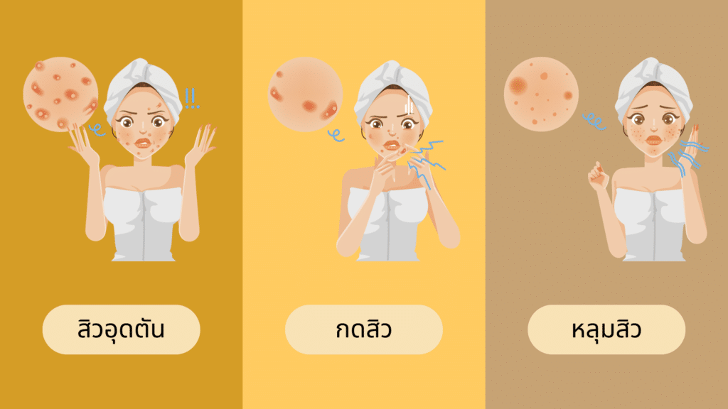 หลุมสิว
