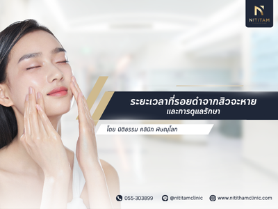 ระยะเวลาที่รอยดำจากสิวจะหาย และการดูแลรักษา