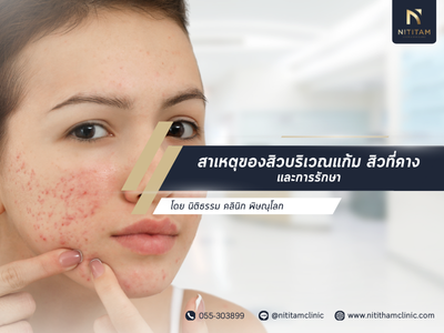 สาเหตุของสิวบริเวณแก้ม สิวที่คาง และการรักษา