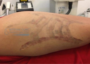 รีวิวหลังลบรอยสัก