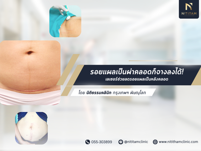 รอยแผลเป็นผ่าคลอดก็จางลงได้! เลเซอร์ช่วยลดรอยแผลเป็นหลังคลอด