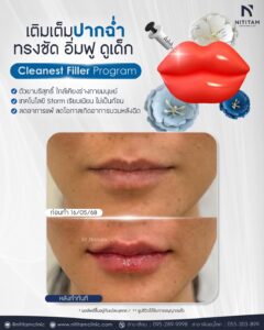 รีวิว เติมฟิลเลอร์