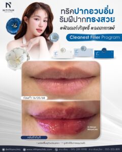 เติมฟิลเลอร์