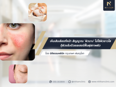 เห็นเส้นเลือดที่หน้า สัญญาณ ‘ผิวบาง’ ไม่ใช่ผิวขาวใส กู้ผิวแข็งด้วยเลเซอร์ฟื้นฟูสภาพผิว