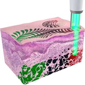 จำลองการแตกตัวของเม็ดสีเมื่อใช้ PicoCare Laser ในการลบรอยสัก