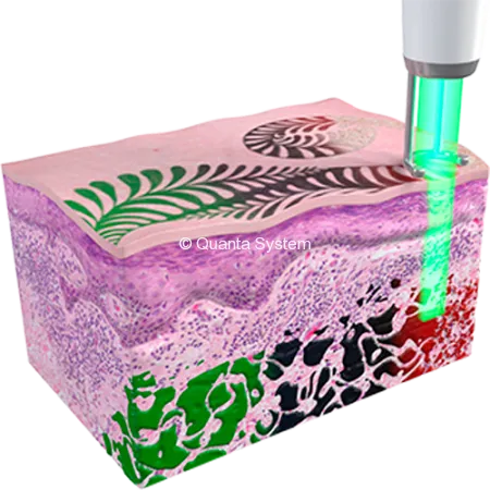 จำลองการแตกตัวของเม็ดสีเมื่อใช้ PicoCare Laser ในการลบรอยสัก