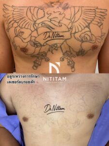 ก่อนและหลัง การลบรอยสัก