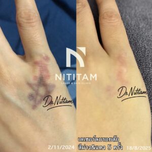ก่อนและหลัง การลบรอยสัก คลินิกนิติธรรม