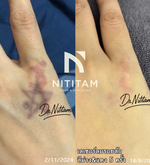 ก่อนและหลัง การลบรอยสัก คลินิกนิติธรรม