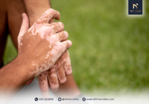 ด่างขาวเกิดจากอะไร