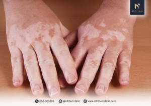 โรคด่างขาว คืออะไร