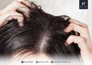 รังแค คืออะไร