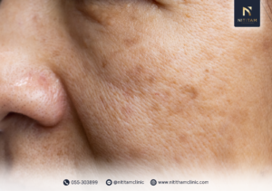 Pico Toning คืออะไร