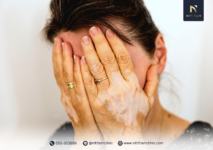 แนวทางการรักษาด่างขาวที่นิยมในทางคลินิก