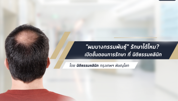 “ผมบางกรรมพันธุ์” รักษาได้ไหม? ไม่ต้องท้อ! เปิดขั้นตอนการรักษา ที่ นิติธรรมคลินิก