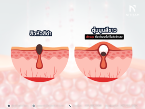 สิวหัวดำ สิวอักเสบ