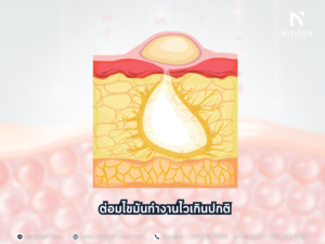 ต่อมไขมัน