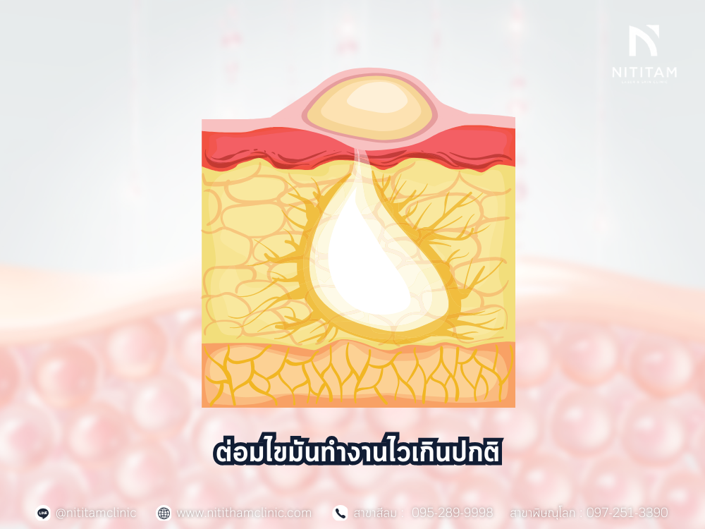 ต่อมไขมัน