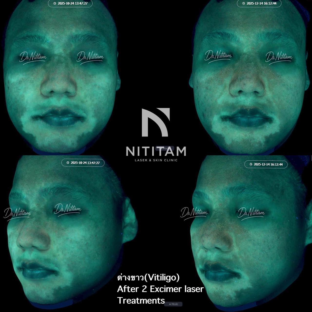 รักษาโรคด่างขาว