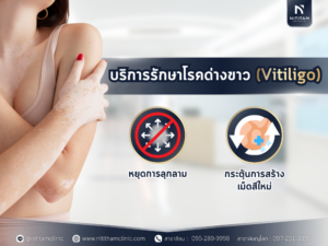 รักษาโรคด่างขาว