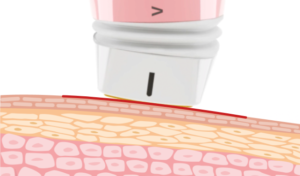 หัว Tip ของ Volnewmer สามารถปรับเอียงตามผิวสัมผัสได้