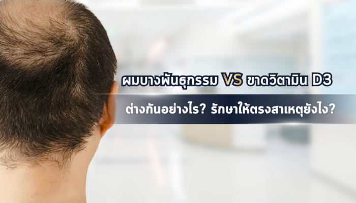 ผมบางพันธุกรรม VS ขาดวิตามิน D3 ต่างกันอย่างไร? รักษาให้ตรงสาเหตุยังไง?