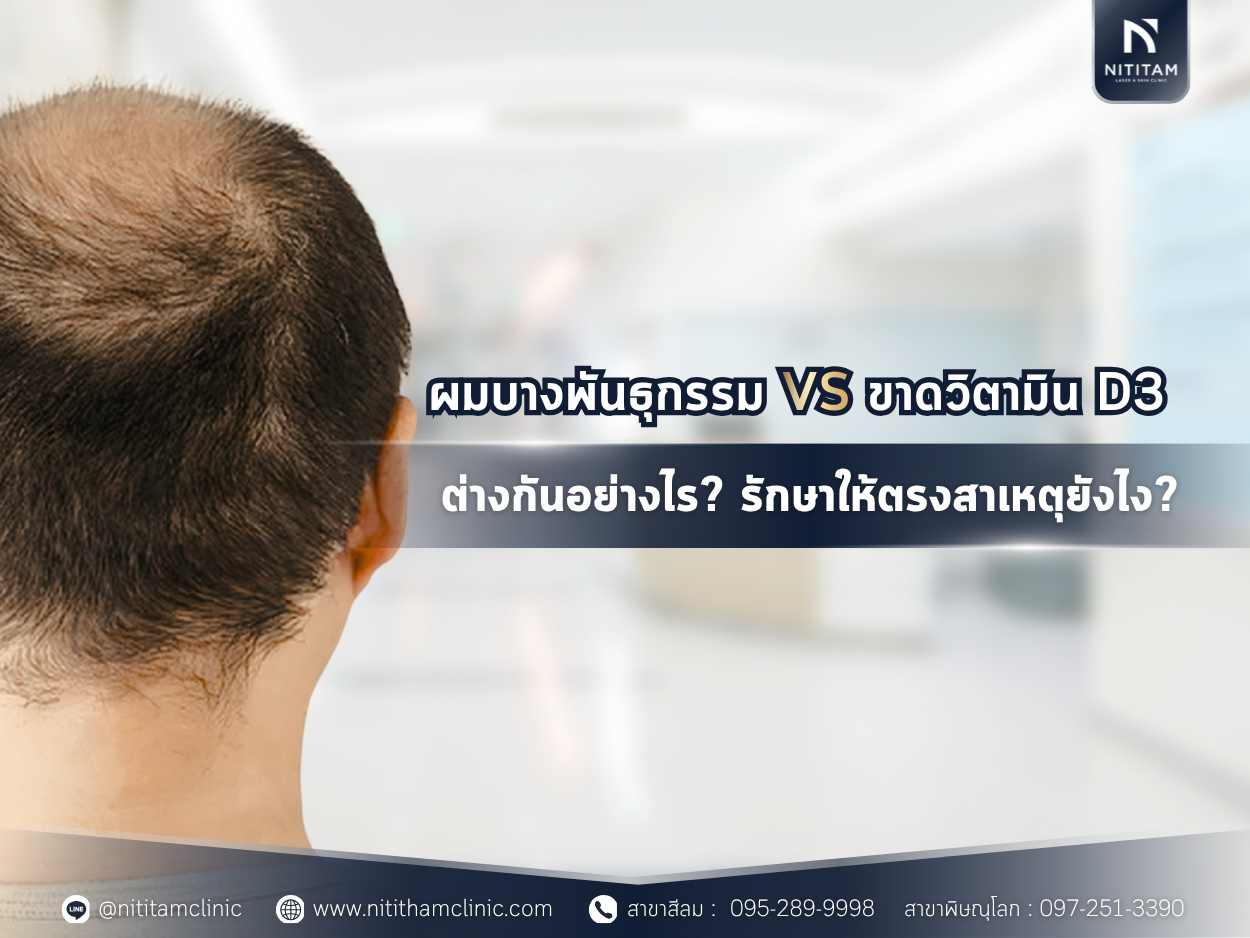 ผมบางพันธุกรรม VS ขาดวิตามิน D3 ต่างกันอย่างไร? รักษาให้ตรงสาเหตุยังไง?