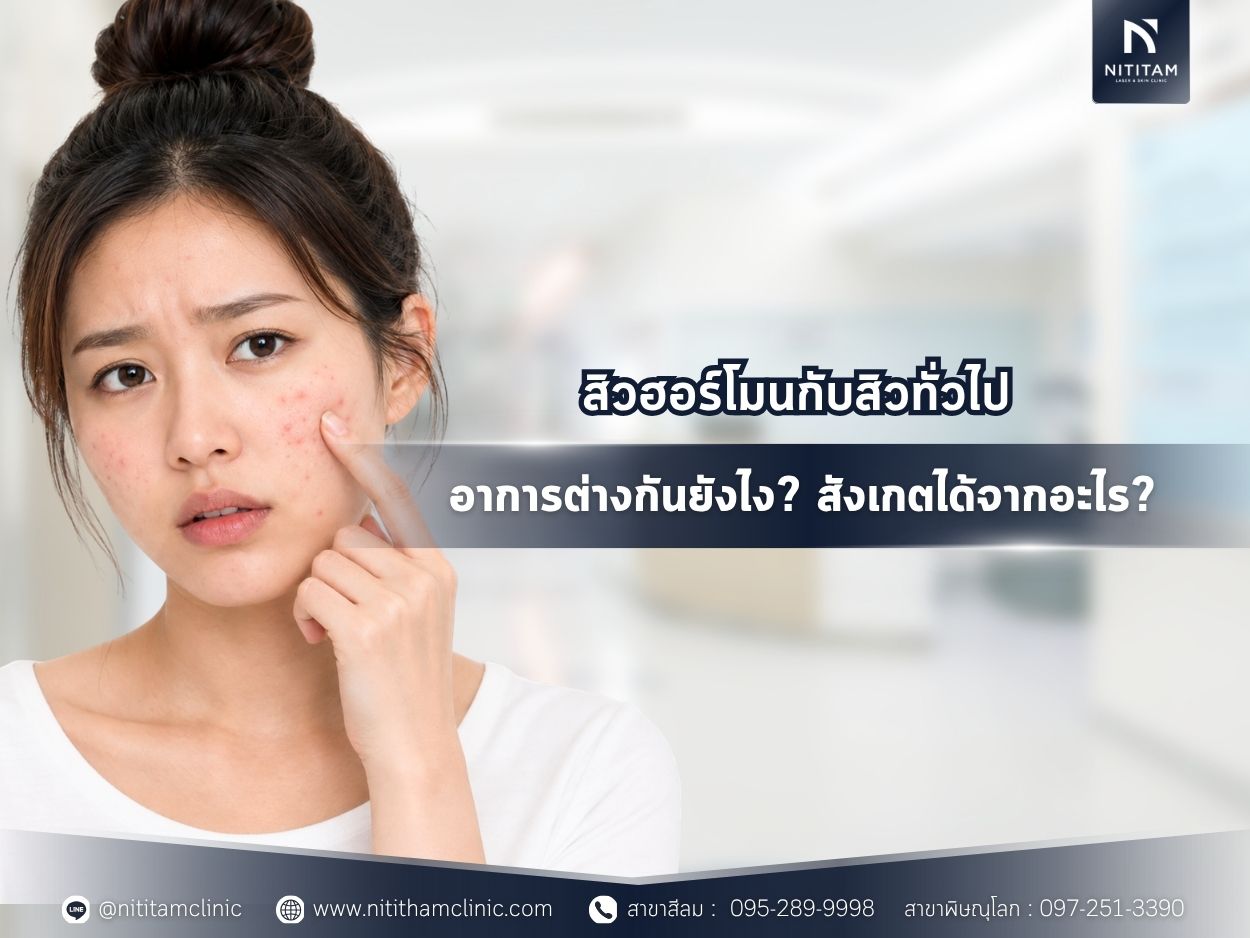 สิวฮอร์โมนกับสิวทั่วไป อาการต่างกันยังไง? สังเกตได้จากอะไร?