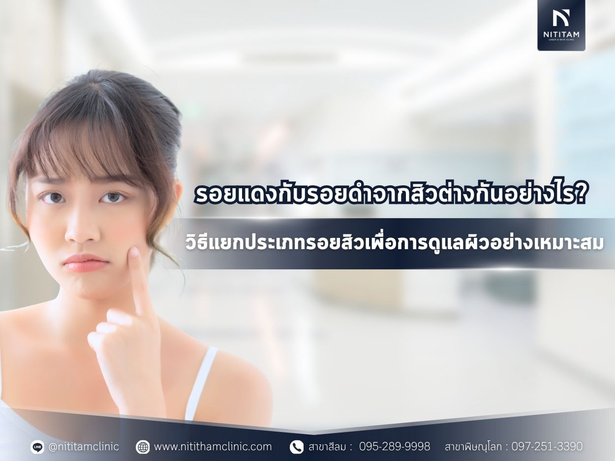 รอยแดงกับรอยดำจากสิวต่างกันอย่างไร? วิธีแยกประเภทรอยสิวเพื่อการดูแลผิวอย่างเหมาะสม