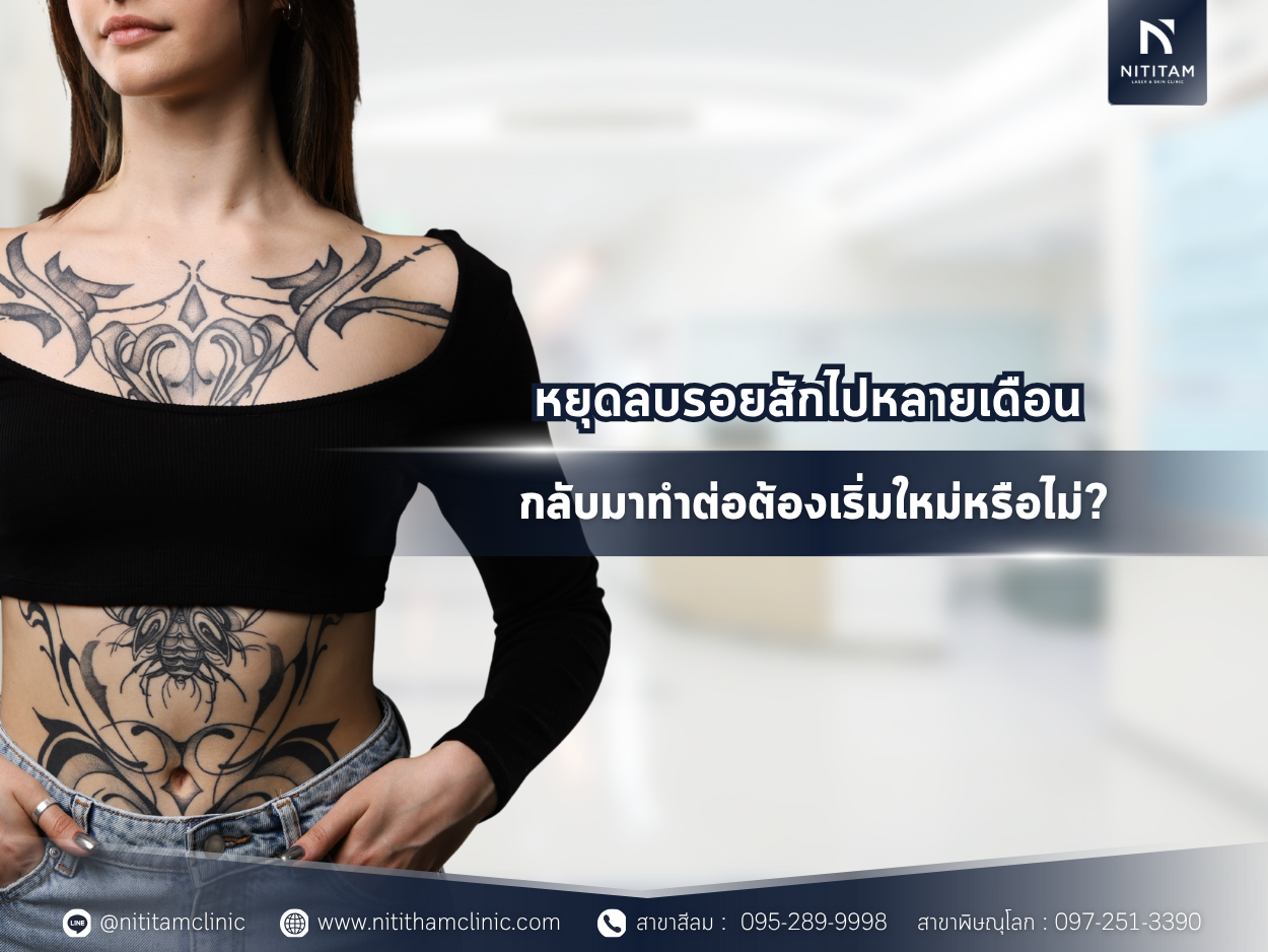 resume-laser-tattoo-removal-after-a-break