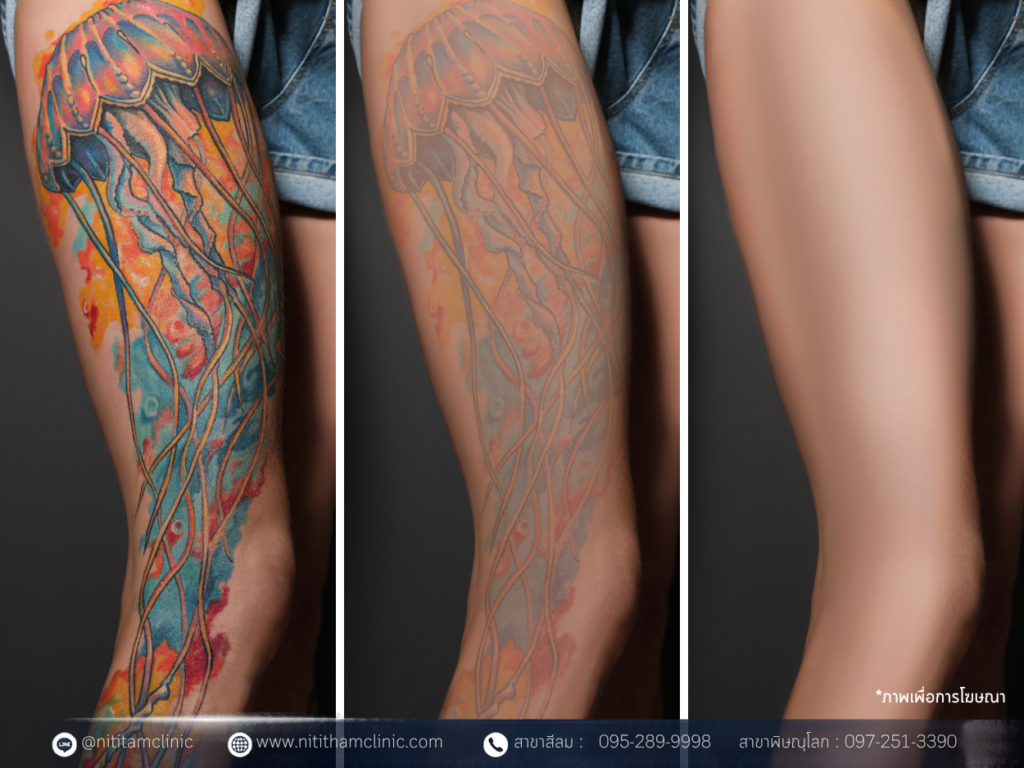 woman before and after laser tattoo removal procedures
