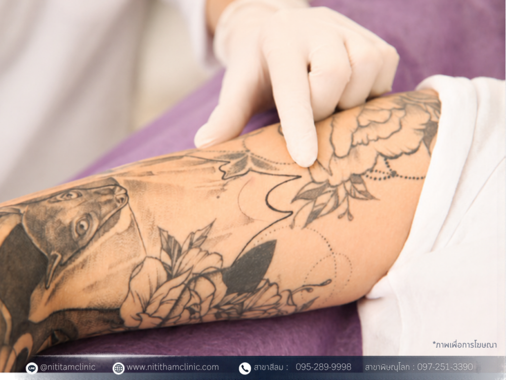 young woman undergoing laser tattoo removal procedure